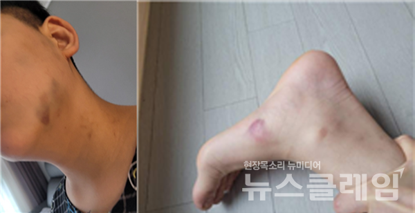 대구의 한 특수학교에서 교사와 사회복무요원이 장애 학생을 폭행했다는 의혹이 제기됐다. 사진=전국장애인부모연대